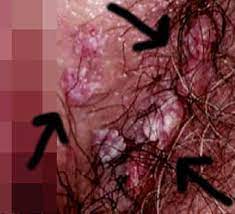 Maybe you would like to learn more about one of these? El Asexuado Y Canalla Virus Del Papiloma