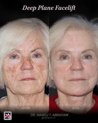 Minimal tension. Maximum transformation. 💫 These before & afters show the  power of the Deep Plane Facelift, a signature procedure by Dr. Manoj T.  Abraham. Unlike traditional techniques, this advanced method lifts