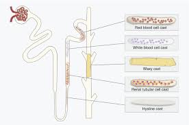 Image result for Urinary Cast