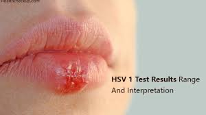 The hsv 1 igg test is a chemiluminescent immunoassay (clia), for use on ids automated analyzers, for quantitative determination of specific igg class antibodies directed against the herpes simplex virus type 1 (hsv 1) in samples of human. Hsv 1 Test Results Range And Interpretation Health Checkup