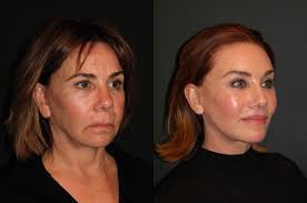 Deep Plane Facelift Before After Dr Andrew Jacono In 2020 Face Plastic Surgery Face Lift Surgery Fractional Laser