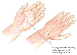 Pellagra is a condition that develops from niacin deficiency (vitamin b3). Niacin Vitamin B3 Mangel An Niacin Uberschuss An Niacin Eesom Gesundheitsportal