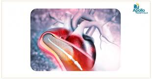 Angioplasty is a procedure to restore blood flow through narrow or blocked arteries. How Is Life After Coronary Heart Angioplasty With One Stent At The Age Of 46 Apollo Hospitals Mumbai Blog
