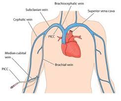 Image result for Peripheral IV Access