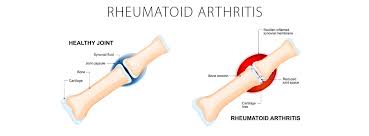 Rheumatoid arthritis is a crippling autoimmune disease that effects the joints of the body. Rheumatoid Arthritis Overview Nonsurgical Options