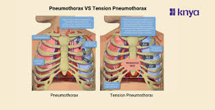 Image result for Open Pneumothorax