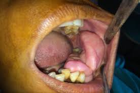 Plexiform fibroma sclerosing fibroma osseous fibroma buccal mucosa cancer buccal mucosa lump buccal mucosa lichen planus buccal mucosa ulcer. An Unusually Large Irritation Fibroma Associated With Gingiva Of Lower Left Posterior Teeth Region