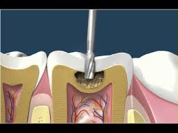 Leonard weiss, practicing dentist and founder of solstice benefits, says he sees many parents question the need to fill cavities in their toddler's teeth since they will eventually fall out. Dental Filling Procedure