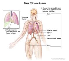In diagnosing lung cancer, but their role in checking whether treatment is working is unproven. Non Small Cell Lung Cancer Treatment Pdq Treatment Patient Information Nci Michigan Medicine