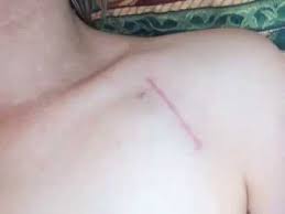 I was wanting to know if it is okay to get tattoos. Icd Scars Slideshow Youtube
