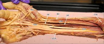 Sonographic appearances of the long tendons of the finger, the flexor digitorum superficialis (fds) and flexor digitorum profundus (fdp). Figure 1 From Bilateral Accessory Flexor Muscle Of The Forearm Giving Rise To A Variant Head Of The First Lumbrical Semantic Scholar