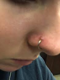 Bump On Nose Piercing I Have Tried Everything And Sometimes It Ll Go Away And Then Come Back Again Tho Any Advice It S Not A Keloid It S A Pustule Have Had Piercing For