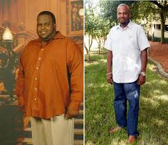 Gastric bypass is surgery that helps you lose weight by changing how your stomach and small intestine handle the food you eat. Patients Experience A Whole New World After Weight Loss Surgery College Of Medicine Jacksonville University Of Florida