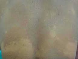 Jun 09, 2021 · microscopically, borderline tuberculoid leprosy shows granulomas associated with peripheral lymphocytes along neurovascular bundles and occasional langhans giant cells. Dermoscopy Of Leprosy Dermnet Nz