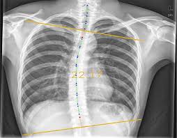 What organ is behind your right lower rib and cup hood : Evaluation Of A Computer Aided Method For Measuring The Cobb Angle On Chest X Rays Springerlink