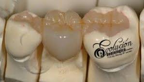 Restauraciones Libres De Metal Evolucion Odontologica