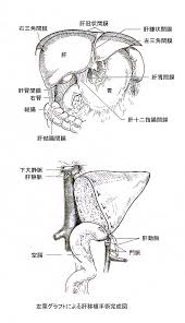 生体肝移植手術方法