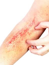 Manchas vermelhas na pele: 11 causas comuns e quando considerar grave