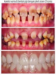 Jacket Crown Zirconia Cosmetic Dental Work Dental Sealants Restorative Dentistry
