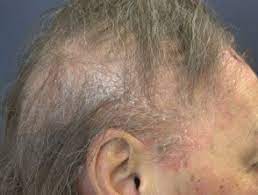 I'm sorry to hear that you're dealing with extreme hair loss,.it certainly is one of those frustrating and challenging symptoms. Scalp Psoriasis Dermnet Nz