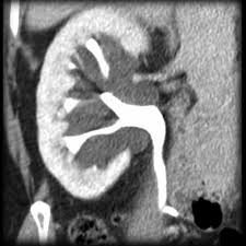 Peripelvic Cysts Radiology Case Radiopaedia Org Radiology Cysts Radiology Imaging