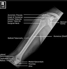 Humerus Xray Medical Radiography Radiology Student Radiology