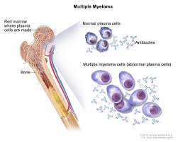 myeloma cdc