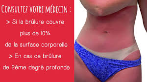 Assez longtemps pour vous donner un coup de soleil convaincant. Que Faire En Cas De Coup De Soleil Youtube