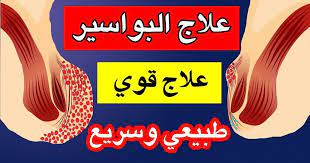 علاج البواسير الداخليه والخارجيه posts facebook