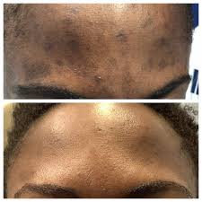 Image result for Hyperpigmentation