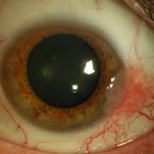 Image result for lesion sclera