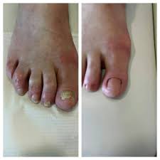 как сделать мазь от грибка ногтей из яйца и уксуса Schimmelnagelbehandeling Voor En Na De Behandeling Met Een Correctiegel Pedicure Nail Art