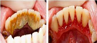 Selain untuk menghilangkan karang gigi, bau mulut yang tidak sedap pun dapat berkurang. Cara Mudah Hilangkan Karang Gigi Dengan Menggunakan Garam Dan Baking Soda Karang Gigi Terus Hilang Kartel Dakwah