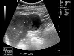 Image result for Splenic Abscess