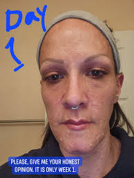 Itchy armpits and under breast area