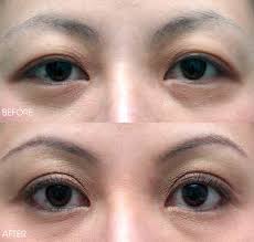 A brow lift is a slightly different procedure. Laser Blepharoplasty Eyebag And Eyelift Removal Belo Medical Group