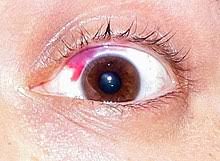 Please select one of the following chicago area lasik locations for more information. Lasik Wikipedia