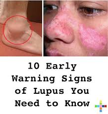 10 Early Warning Signs Of Lupus You Need To Know Warning Signs Lupus Symptoms Lupus