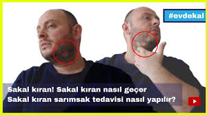 Sakal Kiran Sakal Kiran Nasil Gecer Sakal Kiran Sarimsak Tedavisi Nasil Yapilir Sakal Kiran Tedavisi Youtube