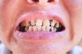أمراض الفم واللثة بالصور المرسال