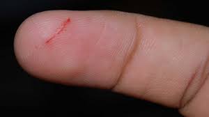 Redness from the infection spreads to other areas, often in streaks. Infected Cut Symptoms Treatment Prevention Complications