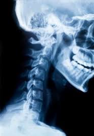 Hws Syndrom Ursachen Symptome Diagnose Behandlung Hausmittel Krank De