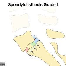 A cast off (also called a bind off) creates an end to your knitting. Spondylolisthesis Physiopedia