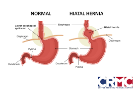 There are two types of hiatal hernia: Could A Hiatal Hernia Be Causing Your Reflux Coffee Regional Medical Center