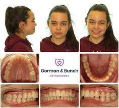 Invisalign Before And After Stories With Our Patients Invisalign After Story Orthodontics