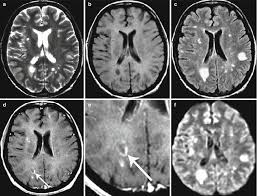 Here, the immune system targets the myelin. Demyelinating Diseases Radiology Key