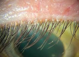 Image result for Demodex brevis
