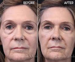 Nasolabial folds, or parentheses, are the deep folds that run from the side of your nose to the corner of your mouth. Juvederm Vollure Xc Riversidemedicalarts Com