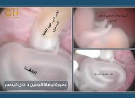 الوهم نصف الداء والإطمئنان نصف الدواء والصبر بداية الشفاء الصور لحالة من حالات الامم تم عمل منظار جنينى لوفاة الجنين داخل الرح sleep eye mask person hospital
