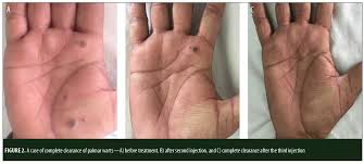 Plantar warts can be refractory to attempted therapeutic interventions. Therapeutic Outcome Of Intralesional Immunotherapy In Cutaneous Warts Using The Mumps Measles And Rubella Vaccine A Randomized Placebo Controlled Trial Jcad The Journal Of Clinical And Aesthetic Dermatology